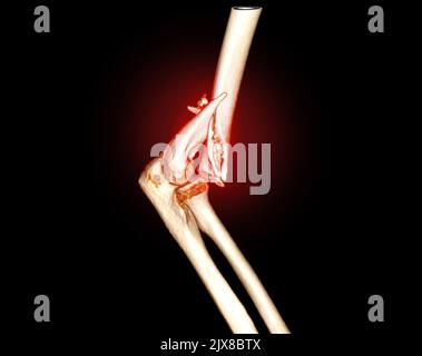 Computertomographie Volumendarstellung Untersuchung des Ellenbogengelenks 3D Rendering in Patientenfraktur Ellenbogengelenk. Stockfoto