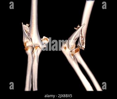 Computertomographie Volumendarstellung Untersuchung des Ellenbogengelenks 3D Rendering in Patientenfraktur Ellenbogengelenk. Stockfoto