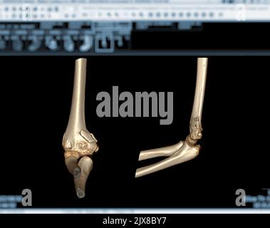 Computertomographie Volumendarstellung Untersuchung des Ellenbogengelenks 3D Rendering in Patientenfraktur Ellenbogengelenk. Stockfoto