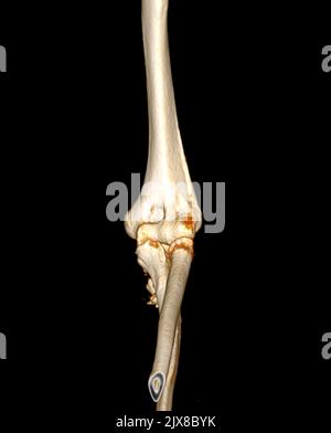 Computertomographie Volumendarstellung Untersuchung des Ellenbogengelenks 3D Rendering in Patientenfraktur Ellenbogengelenk. Stockfoto