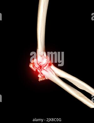Computertomographie Volumendarstellung Untersuchung des Ellenbogengelenks 3D Rendering in Patientenfraktur Ellenbogengelenk. Stockfoto