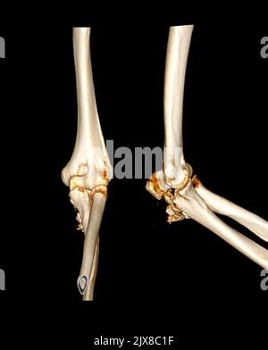 Computertomographie Volumendarstellung Untersuchung des Ellenbogengelenks 3D Rendering in Patientenfraktur Ellenbogengelenk. Stockfoto