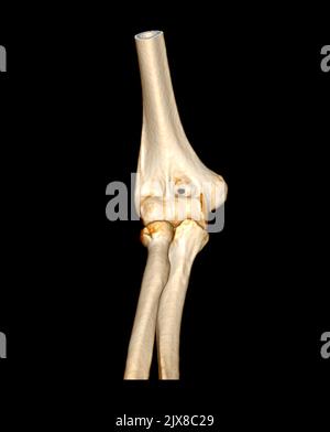 Computertomographie Volumendarstellung Untersuchung des Ellenbogengelenks 3D Rendering in Patientenfraktur Ellenbogengelenk. Stockfoto