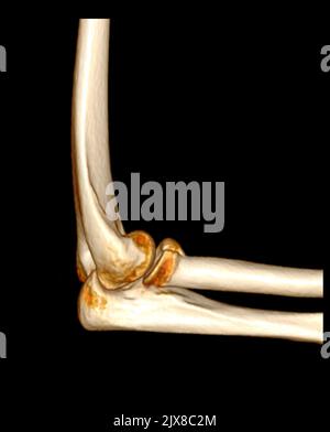 Computertomographie Volumendarstellung Untersuchung des Ellenbogengelenks 3D Rendering in Patientenfraktur Ellenbogengelenk. Stockfoto