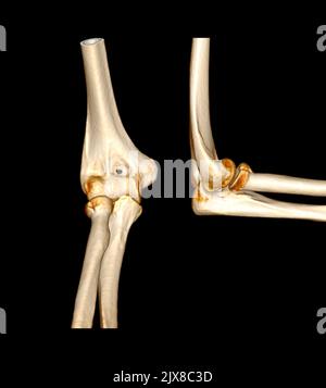 Computertomographie Volumendarstellung Untersuchung des Ellenbogengelenks 3D Rendering in Patientenfraktur Ellenbogengelenk. Stockfoto