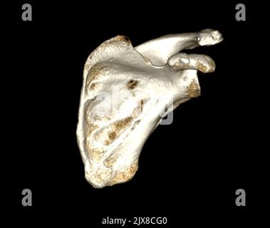 Computertomographie Volumendarstellung Untersuchung der Schulter 3D Rendering in Patientenfraktur Schultergelenk. Stockfoto