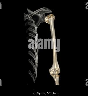 Computertomographie Volumen-Rendering-Untersuchung des Schultergelenks und des Humerusknochens 3D mit Fraktur des Schultergelenks des Patienten und des Humerus bo Stockfoto