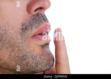 Anwendung von Creme für die medizinische Behandlung von Lippenherpes im Mund eines Mannes Stockfoto