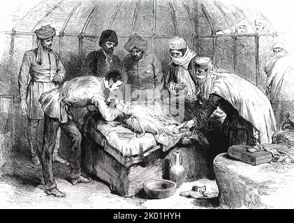 CW Owen, Chirurg bei der Afghan Boundary Commission, führt eine plastische Operation an einer Frau durch, die ins Feuer gefallen war und ihr Gesicht um das Auge verbrannte. Patient unter Chloroform. Aus Den Illustrated London News, 1885. Stockfoto