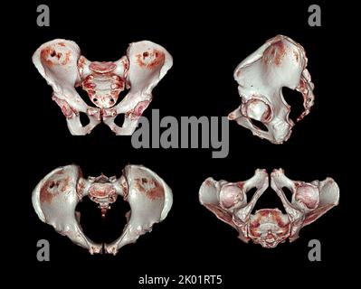 CT-Scan von Becken- und Hüftgelenk 3D zur Diagnose Fraktur von Becken- und Hüftgelenk isoliert auf weißem Hintergrund. Stockfoto