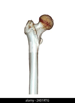 CT-Scan des Femurknochens und Oberschenkelknochens 3D zur Diagnose Fraktur des Femurknochens isoliert auf weißem Hintergrund. Beschneidungspfad. Stockfoto