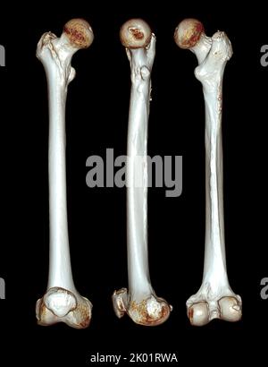 CT-Scan des Femurknochens und Oberschenkelknochens 3D zur Diagnose Fraktur des Femurknochens auf schwarzem Hintergrund isoliert. Beschneidungspfad. Stockfoto