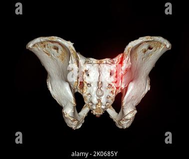 CT-Scan des Sacroiliac-Gelenks und Hüftgelenks 3D zur Diagnose Fraktur des Sacroiliac-Gelenks und Hüftgelenks Stockfoto