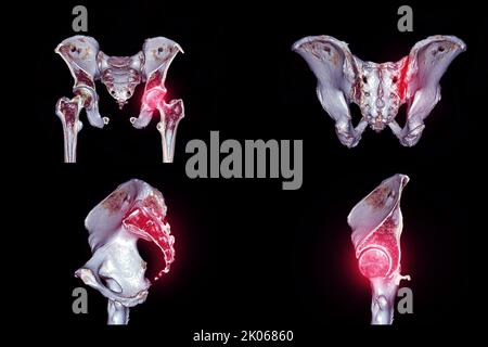 Sammlung eines traumatischen Fall-CT-Scans von Beckenknochen und Hüftgelenk 3D zur Diagnose Fraktur des Beckenknochens isoliert auf schwarzem Hintergrund. Stockfoto