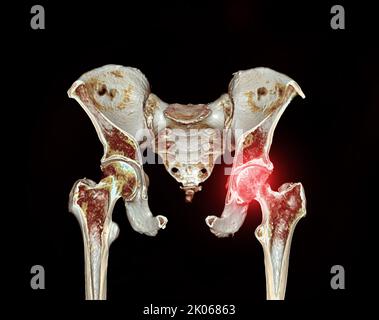 CT-Scan von Becken- und Hüftgelenk 3D zur Diagnose Fraktur von Becken- und Hüftgelenk isoliert auf schwarzem Hintergrund. Stockfoto