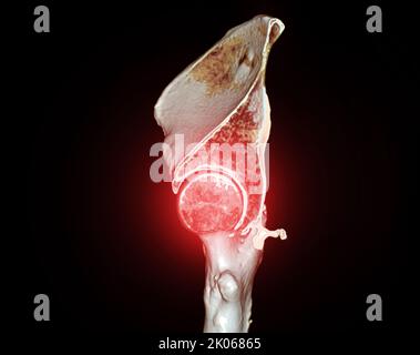 CT-Scan von Becken- und Hüftgelenk 3D zur Diagnose Fraktur von Becken- und Hüftgelenk isoliert auf schwarzem Hintergrund. Stockfoto