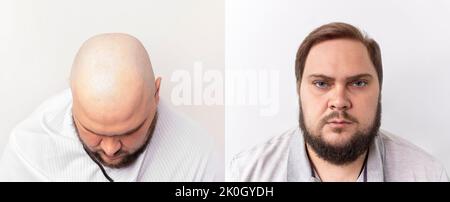 Vor und nach dem kahlen Kopf eines Mannes. Der Prozess der Haartransplantation auf dem Kopf. Behandlung von Haarausfall. Stockfoto