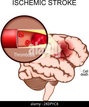 Ischämischer Schlaganfall. Menschliches Gehirn. Nahaufnahme eines Blutgerinnsels in einer Arterie, was zum Hirntod in den betroffenen Bereich führt. Thrombose. Hirninfarkt Stock Vektor