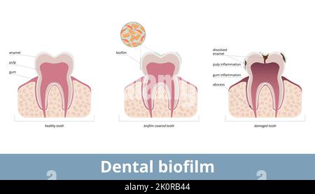Dentaler Biofilm. Biofilm bedeckt die Zähne und verursacht die Schmelzodesolvation, die Entzündung des Zahnfleisches und des Pulpa. Biofilm auf einem Zahn schädigt das Zahngewebe Stock Vektor