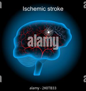 Hirninfarkt. Ischämischer Schlaganfall. Menschliches Gehirn mit Blutgefäß auf dunklem Hintergrund. Hirn-Ischämie, die durch ein Blutgerinnsel in einer Arterie verursacht wird, was zu i führt Stock Vektor