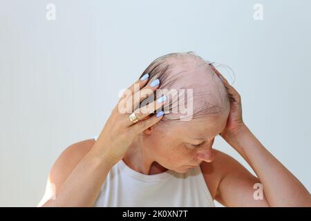 Haarausfall in Form von Alopecia areata. Kahlköpfiger Kopf einer Frau. Haarausfall nach Covid. Kahle Stellen mit totaler Alopezie Stockfoto