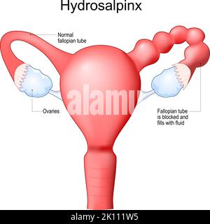 Menschliche Gebärmutter mit verstopftem Eileiter. Hydrosalpinx verursacht Unfruchtbarkeit. Weibliches Fortpflanzungssystem. Frontalansicht. Menschliche Anatomie. Realistisch Stock Vektor