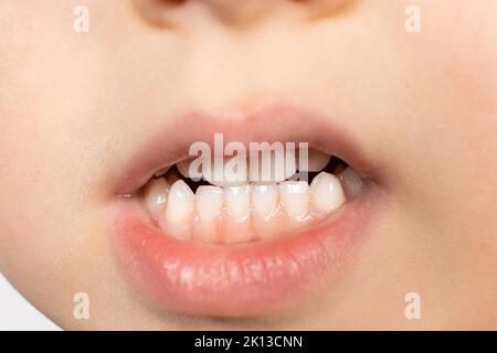 Milchzähne eines fünfjährigen Kindes - Biss, Zahnbelag, Hygiene und Pflege. Stockfoto