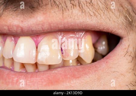 Plaque auf menschlichen Zähnen ist rosa mit Indikatortabletten gefärbt. Stockfoto