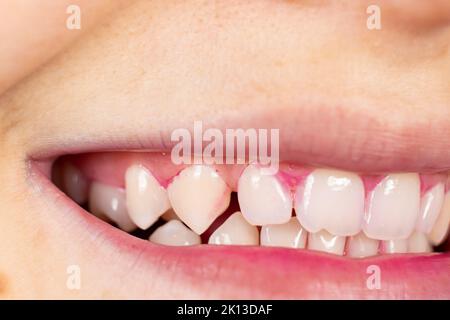 Plaque auf menschlichen Zähnen ist rosa mit Indikatortabletten gefärbt. Stockfoto