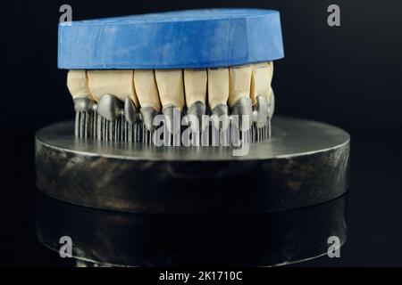 Zahnkronen auf 3D Drucker für Metall erstellt. Gipsmodell auf einem bedruckten Metallrahmen Stockfoto