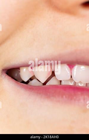 Plaque auf menschlichen Zähnen ist rosa mit Indikatortabletten gefärbt. Stockfoto