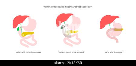 Medizinische Infografik des whipple-Verfahrens Pankreaticoduodenektomie. Operation Operation bei der Behandlung von Bauchspeicheldrüsenkrebs. Stock Vektor