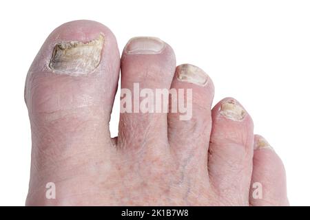 Nahaufnahme eines älteren männlichen Fußes, der einen schlechten Fall von Zehennagelpilz oder einen Fuß eines Athleten auf weißem Hintergrund isoliert Stockfoto