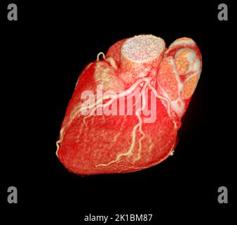 CT Cardiac 3D oder CTA Koronararterie zur Prävention von koronaren Herzerkrankungen. Stockfoto