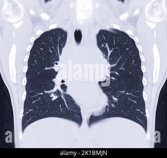 CT Chest Coronal MIP-Ansicht für diagnostische Lungenembolie (PE), Lungenkrebs und Covid-19. . Stockfoto