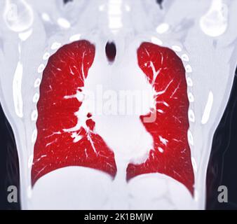 CT Chest Coronal MIP-Ansicht für diagnostische Lungenembolie (PE), Lungenkrebs und Covid-19. . Stockfoto