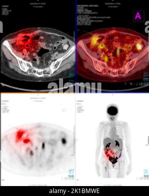 Bei der Positronen-Emissions-Tomographie (PET) wird ein radioaktives Medikament (Tracer) verwendet, um sowohl die normale als auch die abnorme metabolische Aktivität des gesamten menschlichen Körpers zu zeigen Stockfoto