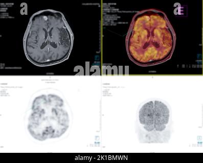 Die Positronen-Emissions-Tomographie (PET) CT-Messung verwendet ein radioaktives Medikament (Tracer), um sowohl normale als auch abnorme Stoffwechselaktivität von KOPF und HALS für zu zeigen Stockfoto