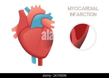 Ungesundes menschliches Herz mit Myokardinfarkt Krankheit Anatomie Illustration Gesundheit Problem Vektor Illustration auf weißem Hintergrund Stock Vektor