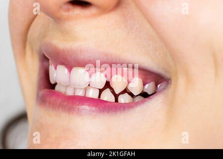 Plaque auf menschlichen Zähnen ist rosa mit Indikatortabletten gefärbt. Stockfoto