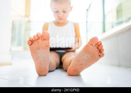 Enterovirus Bein - Arm - Mund. Hautausschlag am Körper eines Kindes. Cocksackie-Virus. Stockfoto