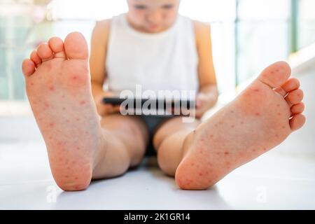 Enterovirus Bein - Arm - Mund. Hautausschlag am Körper eines Kindes. Cocksackie-Virus. Stockfoto