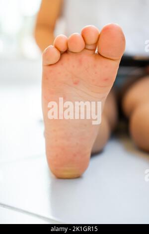 Enterovirus Bein - Arm - Mund. Hautausschlag am Körper eines Kindes. Cocksackie-Virus. Stockfoto