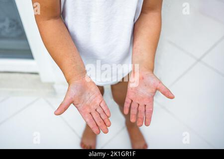 Enterovirus Bein - Arm - Mund. Hautausschlag am Körper eines Kindes. Cocksackie-Virus. Stockfoto