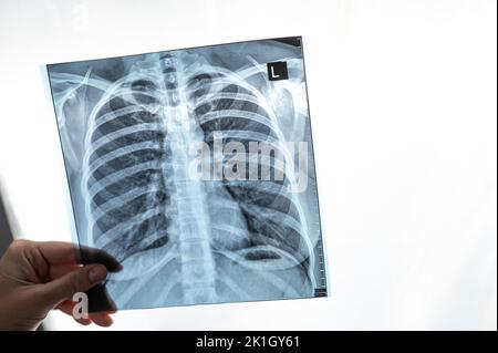 Arzt zeigt Röntgenaufnahme der Lunge des Patienten. Stockfoto