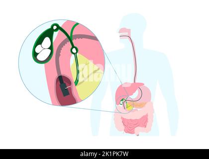 Endoskopische Entfernung von Gallenblasenstein durch Mund, Magen, Gallengang. Infografiken zur medizinischen Operation. Vektorgrafik Stock Vektor