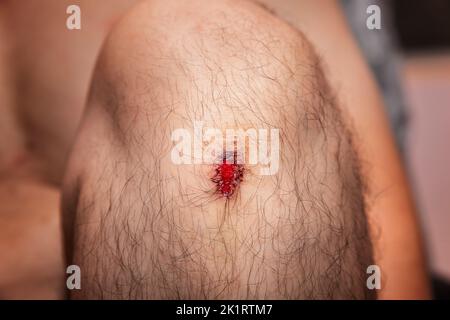 Nahaufnahme der frischen Wunde am Knie des Mannes vor Unfall. Stockfoto
