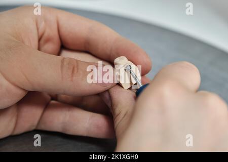 Nahaufnahme eines Zahntechnikers, der an einer Zahnkrone arbeitet. Zahnhalsgravur auf einem Gipsmodell Stockfoto