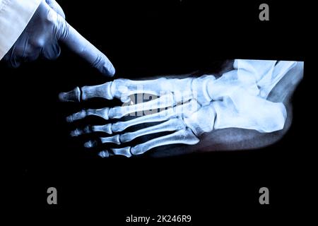 Röntgenbild des Fußes. Der Arzt zeigt mit dem Finger auf die Wucherungen am Knochen. Stockfoto