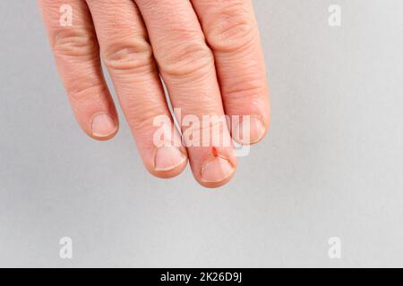 Kleine Wunde am Finger, frisches Blut nach Verletzungen, Nahaufnahme, Blutungen Stockfoto